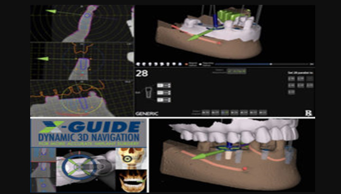 The ideal replacement for missing teeth from latest Navigation technique is our clinic speciality.