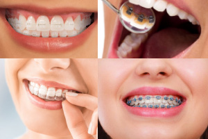 Advanced Braces Treatment