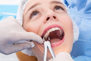 Dental Extractions