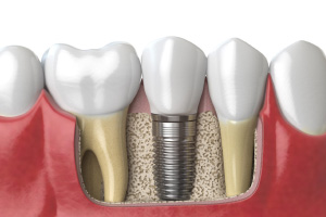 Dental Implant